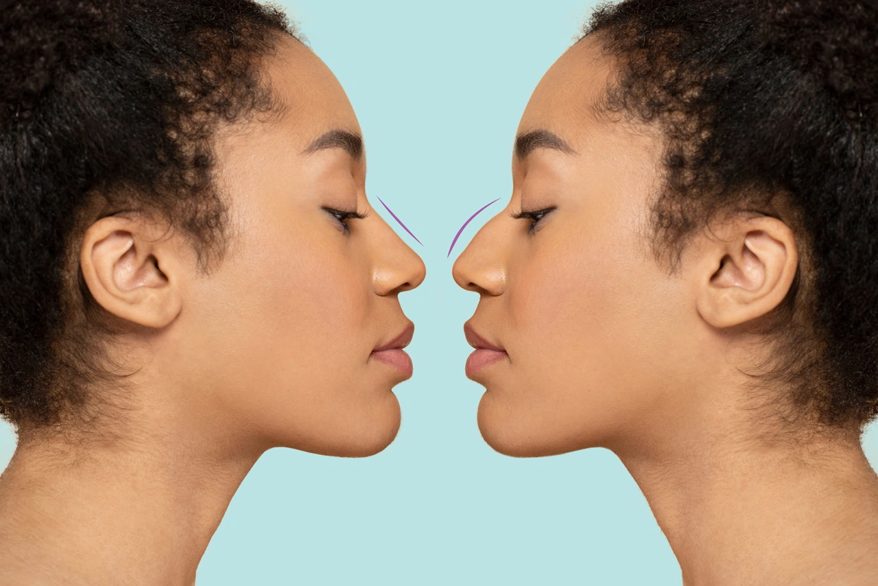 woman-getting-ready-nose-job-surgery